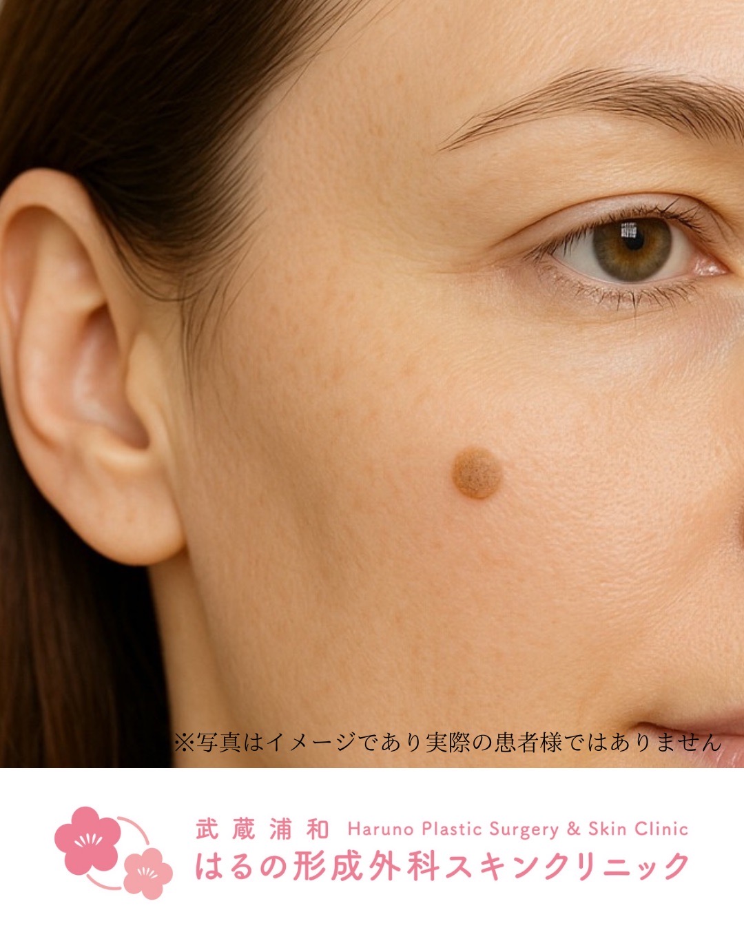 顔のイボをキレイにする方法！【形成外科専門医・宮﨑院長監修】