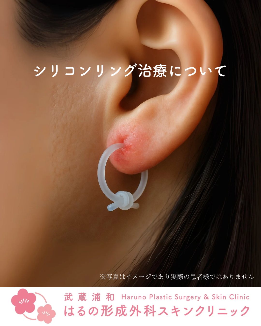 【形成外科専門医・宮﨑院長監修】ピアスの炎症・膿・ケロイドでお悩みの方へ：「シリコンリング治療」という選択肢【症例写真あり】|武蔵浦和はるの形成外科スキンクリニック