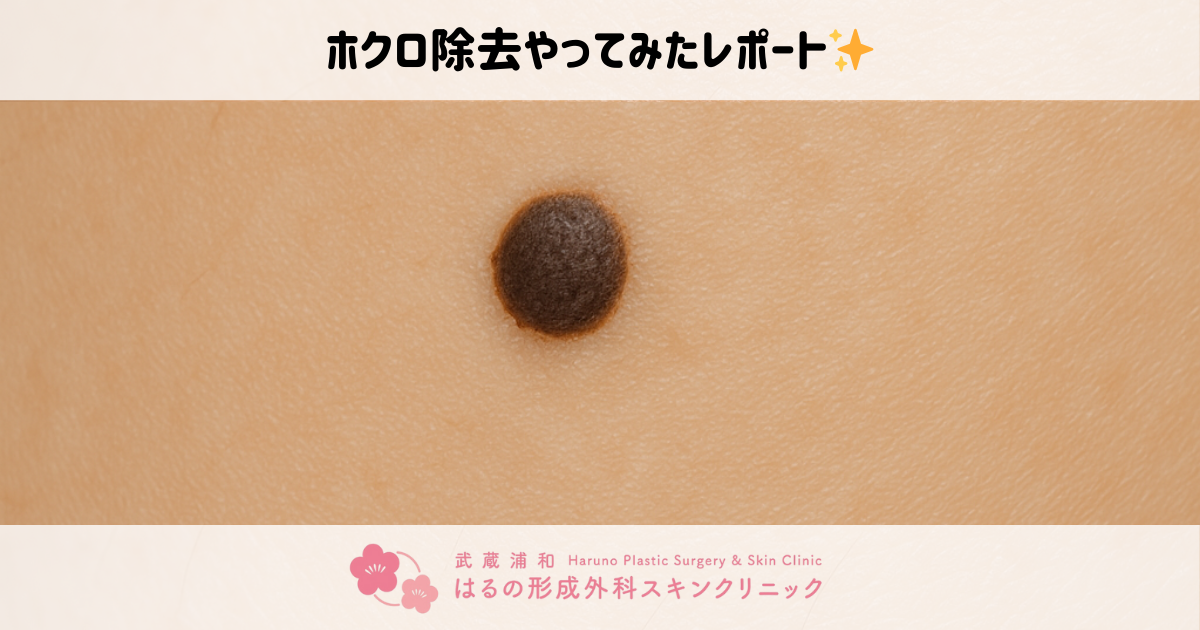 ✂️スタッフが実際に受けてみた！形成外科専門医による『ほくろ除去』体験レポート🦵（症例写真あり）
