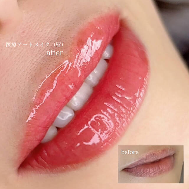 唇のビフォー アフター