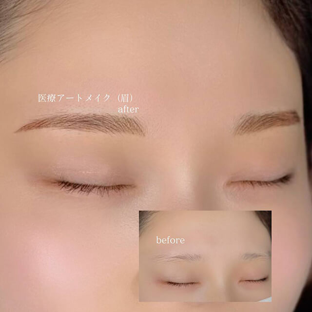 眉のビフォー アフター②