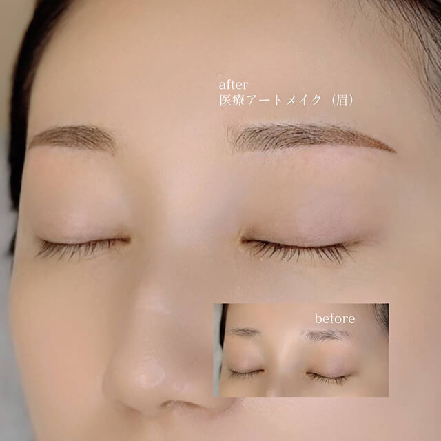 眉のビフォー アフター③