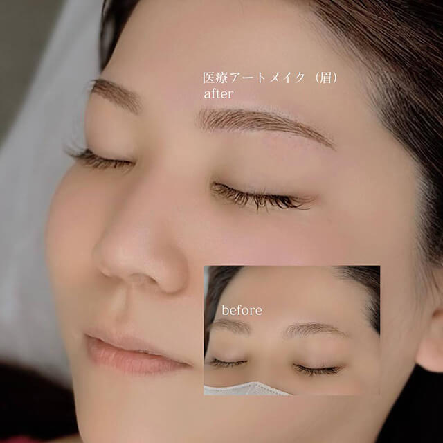 眉のビフォー アフター④
