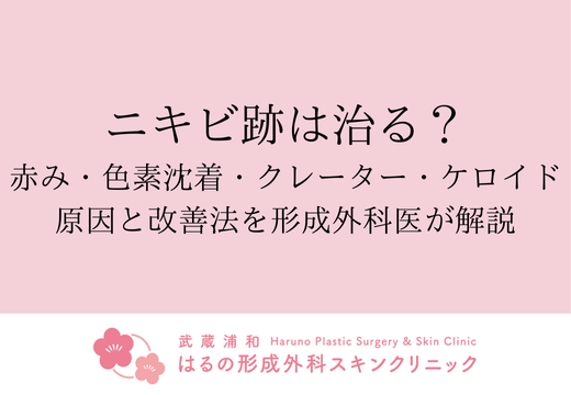 ニキビ跡は治る？赤み・色素沈着・クレーター・ケロイドの原因と改善法を形成外科医が解説