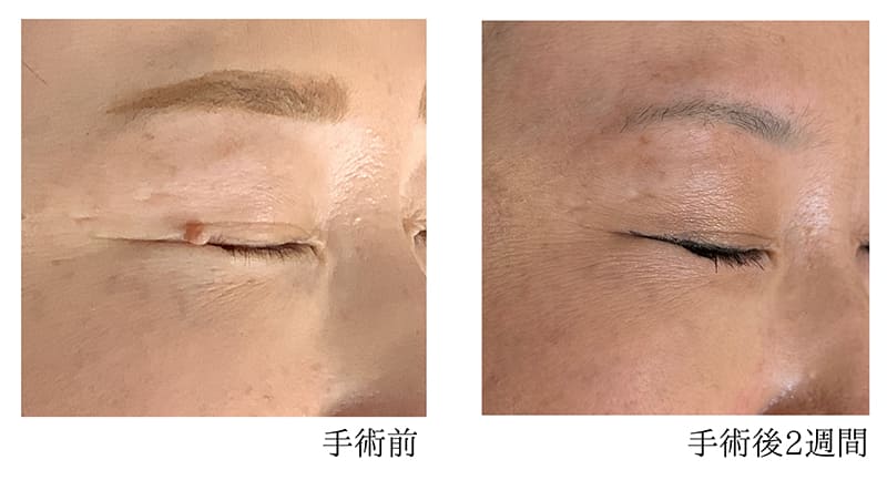 目元のほくろ 症例