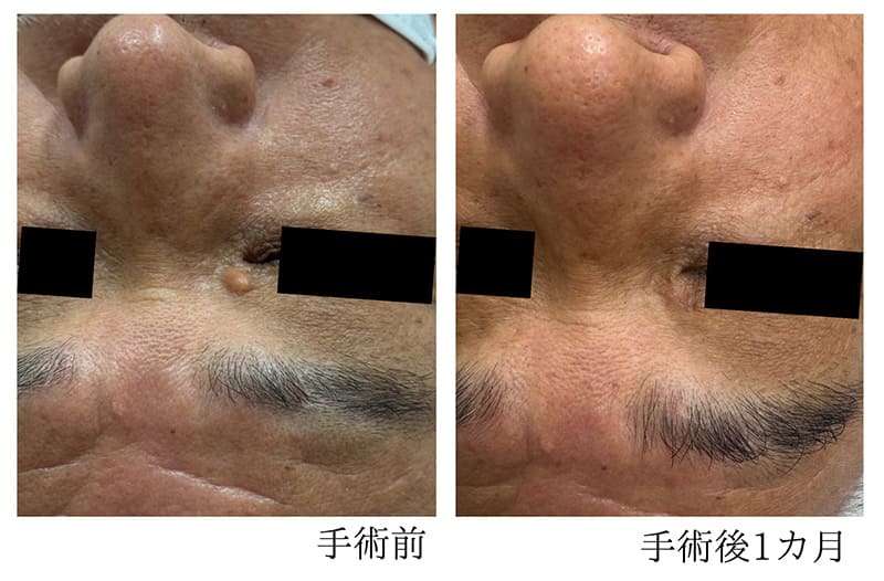 目元のほくろ 症例2