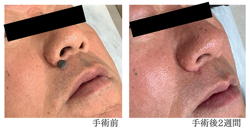 鼻下のほくろ 症例