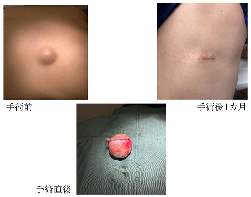 背中の粉瘤 症例