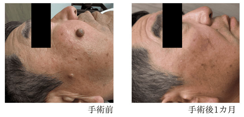 頬のほくろ 症例