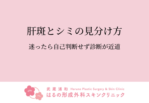 肝斑とシミの見分け方。迷ったら自己判断せず診断が近道